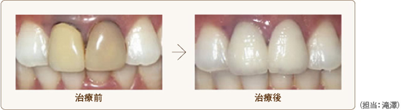 メタルボンドクラウン