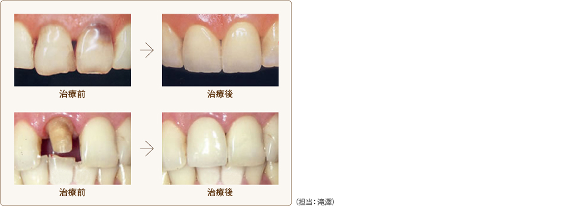 ジルコニアＥ－ＭＡＸ