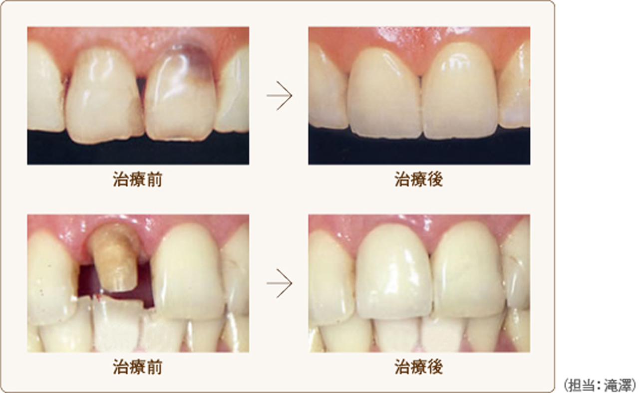 ジルコニアＥ－ＭＡＸ