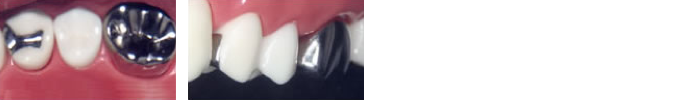 パラクラウン（銀歯）