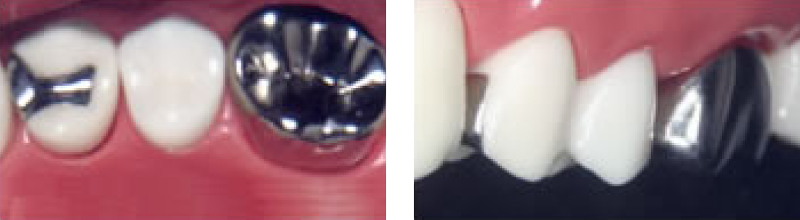 パラクラウン（銀歯）