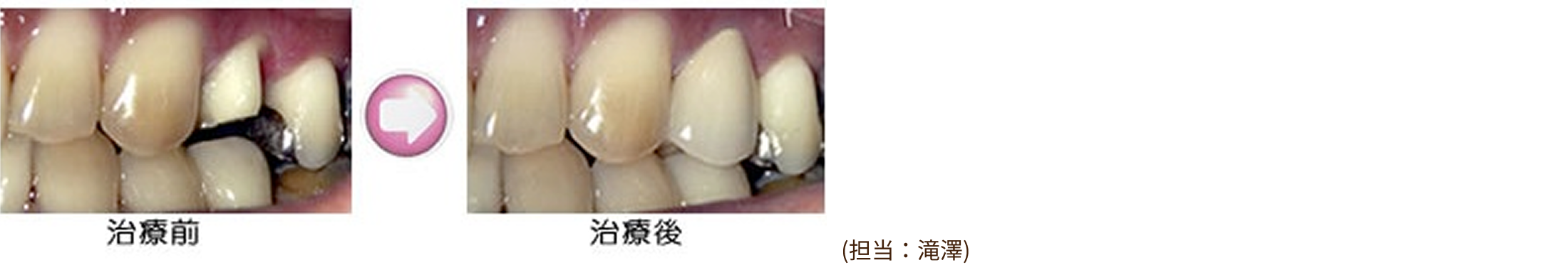 治療例（メタルボンド）