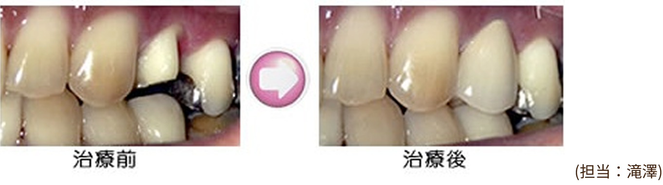 治療例（メタルボンド）