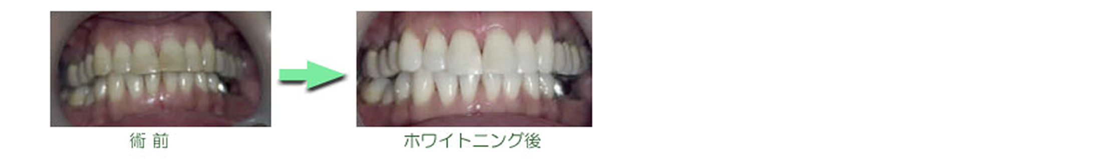 ホワイトニング　症例集