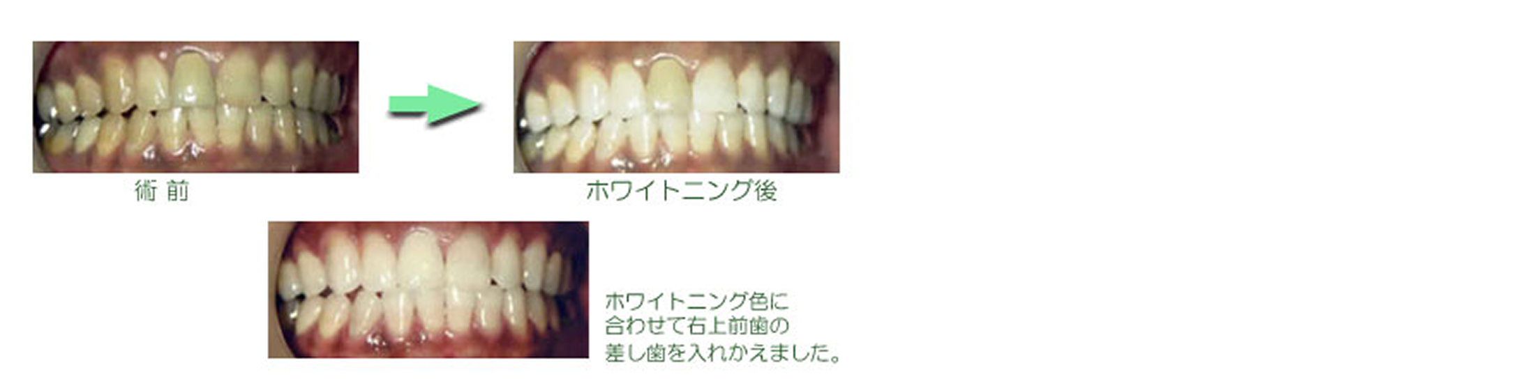 ホワイトニング　症例集