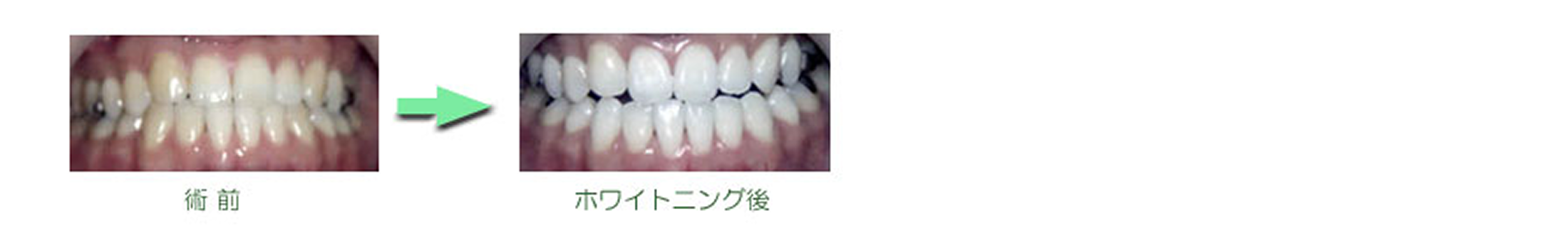 ホワイトニング　症例集