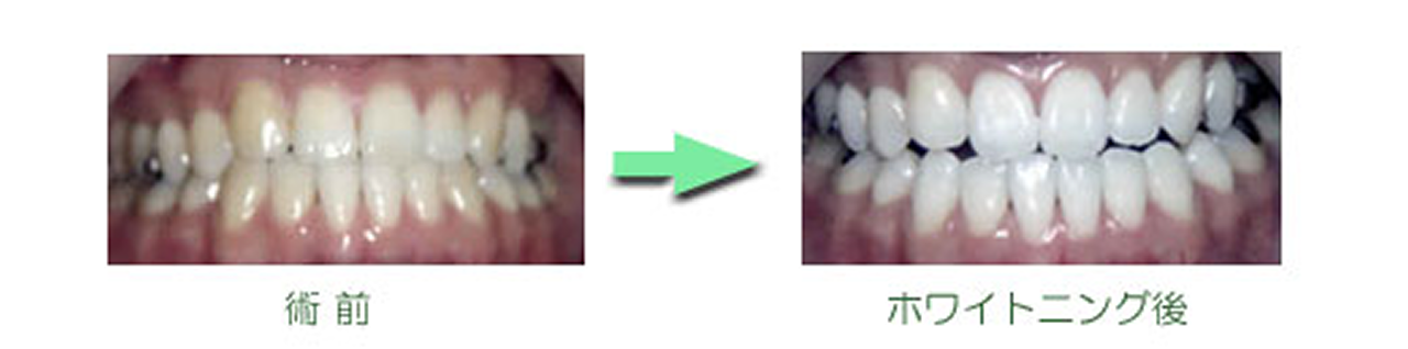 ホワイトニング　症例集