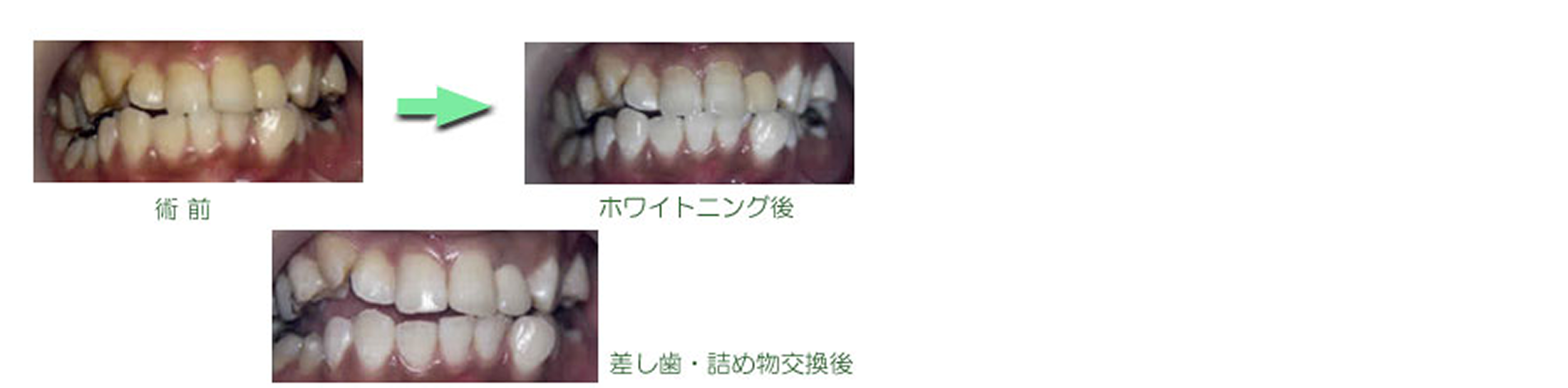 ホワイトニング　症例集