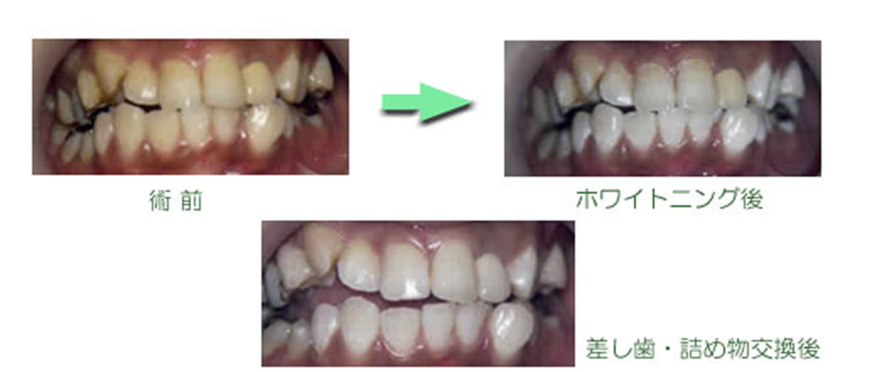 ホワイトニング　症例集