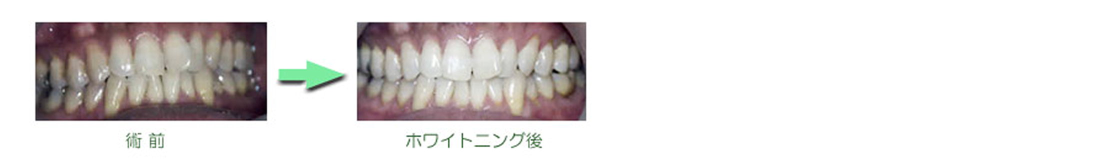 ホワイトニング　症例集