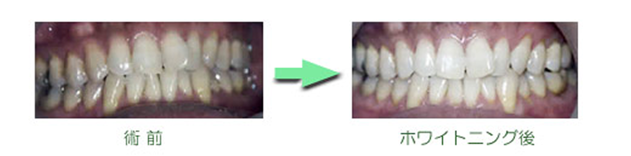 ホワイトニング　症例集