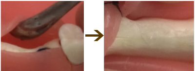 歯茎に小さい穴をあける