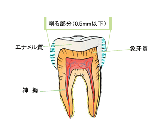 非抜歯1