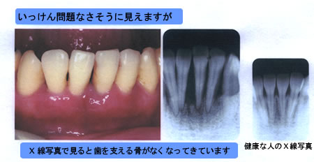 歯周病治療1