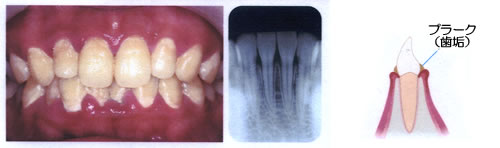 歯周炎1