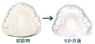 マウスピース矯正 最新式矯正治療法 矯正歯科 藤沢市で歯科をお探しなら 湘南藤沢歯科